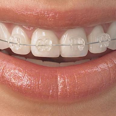 Braces image