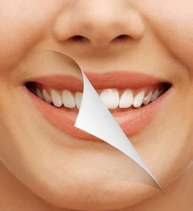 Full mouth rehabilitation image