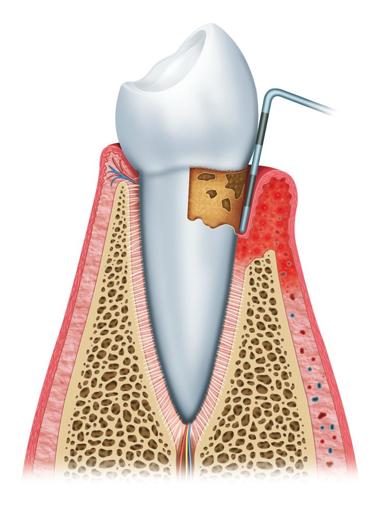 Gum disease treatment image